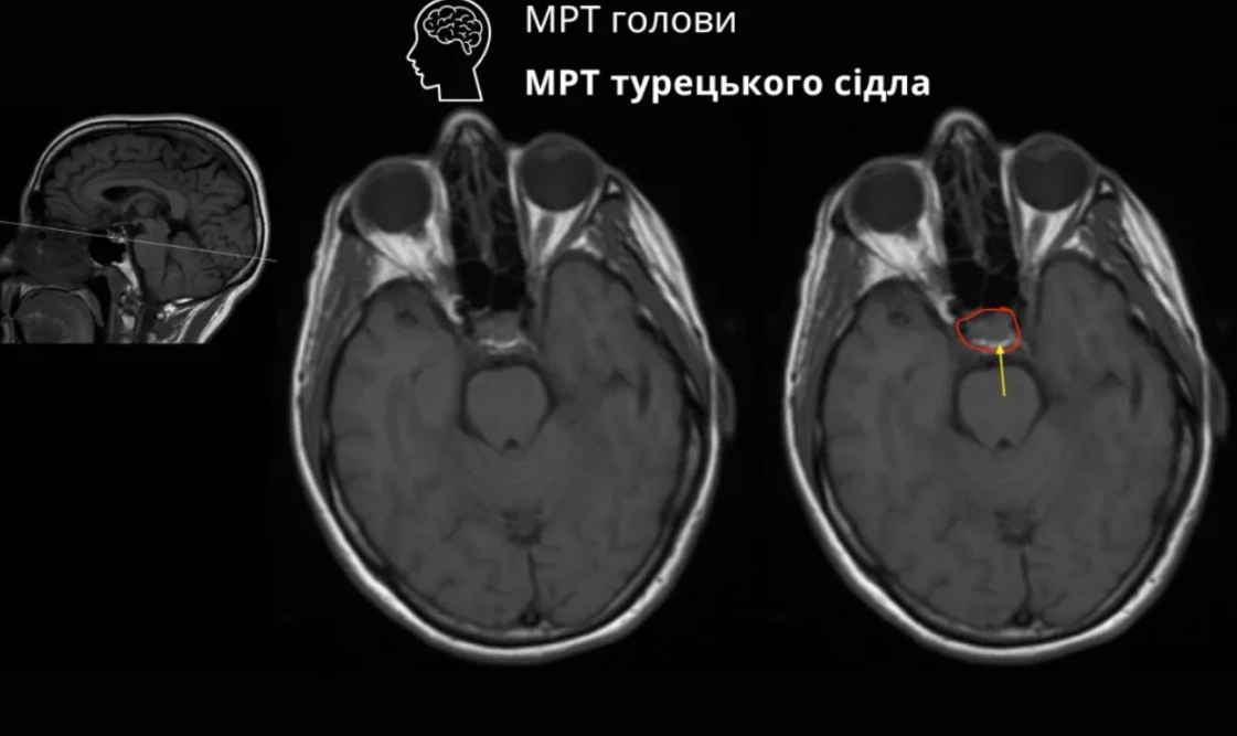 Як не пропустити вогнищеві прояви - повна інструкція для 2025 року